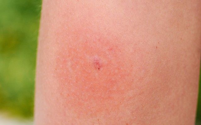 Nahaufnahme einer Hautstelle mit einer kreisrunden, stark geröteten und geschwollenen Entzündung um einen zentralen Insektenstich.